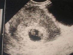胎嚢 見え 週 ない 5 妊娠5週・6週の中絶手術を検討している方へ｜母体の特徴と手術内容